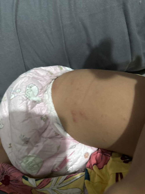 Bintik-bintik pada kulit