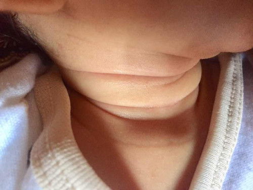 Kemerahan dilipatan leher