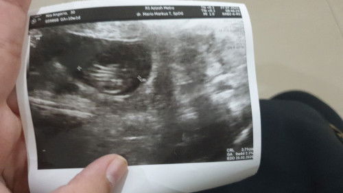 Usg 9minggu 4 hari diaplikasi 10 minggu 4 hari