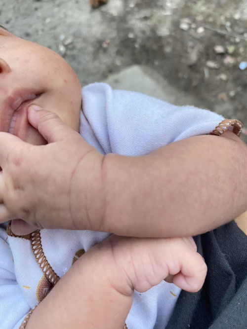 Kulit Bayi Bercak Kebiruan