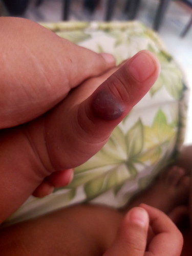 Mommy pa help naman anu pwede gamot sa blister sa thumb ni Lo ko.
Kakathumb suck nya tinubuanblister