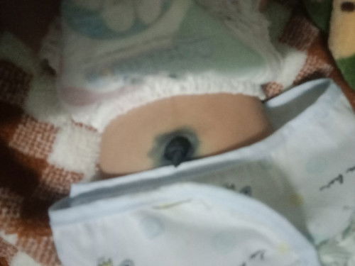 น้อง20วันสะดือยังไม่หลุดผิดปกติไหมค่ะ