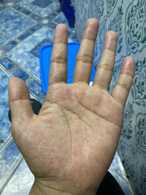 Tapak tangan ada bintik bintik merah  gatal gatal
