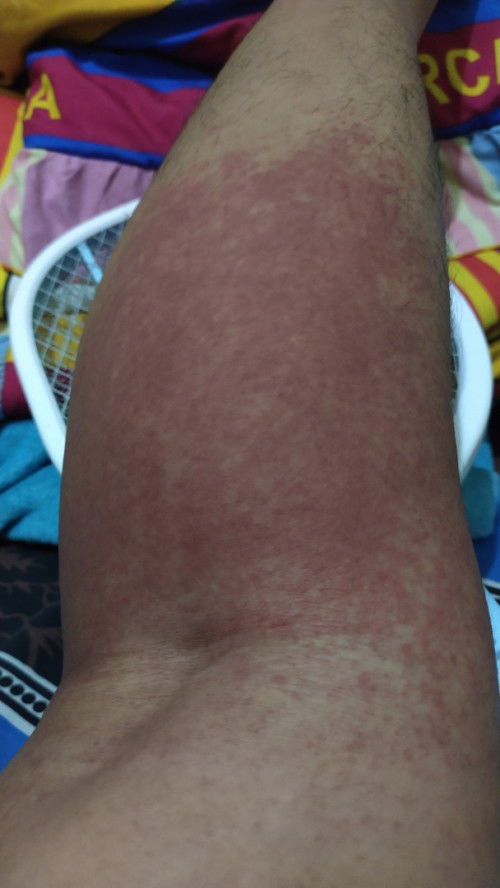 Kaki ruam merah perih linu bengkak