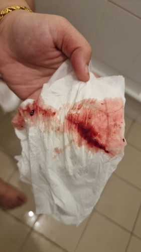 Bleeding without pain.