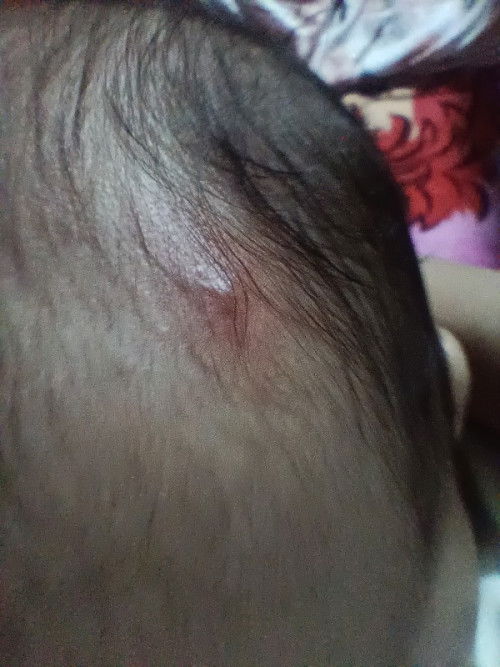 Hello po, sana may makatulong ano po kaya tong tumutubo sa ulo ng baby ko, first time mom po ako kay