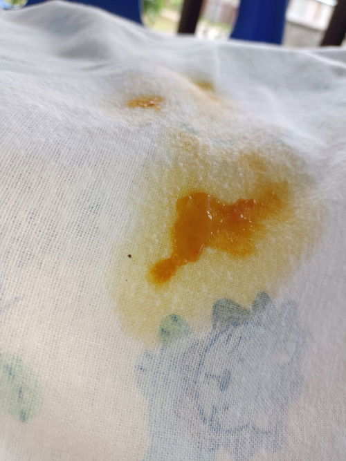 น้องอายุ 2 เดือน 15 วัน แบบนี้ใช่ถ่ายเป็นเลือดไหมคะ