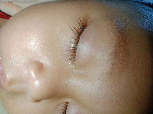 #ลูกมีขี้ตาเยอะ