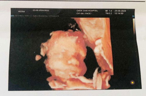 ส่วนใหญ่น้องกลับหัวช่วงกี่สัปดาห์คะ บ้านนี้ไม่อยากผ่าเลยคะ คนที่4 แล้ว 3 คนแรกคลอดธรรมชาติหมดเลยคะ ตอนนี้ 32w คะ