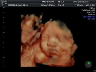 30+4 วีค ลูกสาวหนัก 1486 g