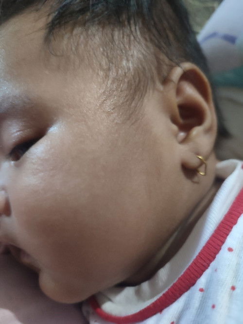 Putih² di pipi dan leher bayi