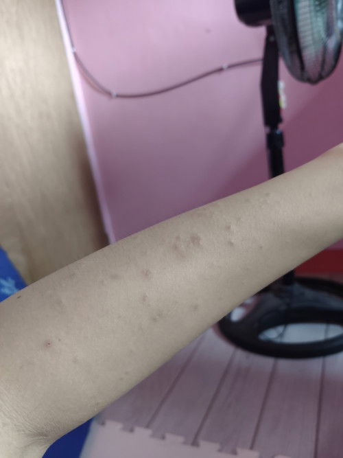 Hi po 1st tym mommy ask ko lang po kung anong pwedeng gmitin pra d gnun matrigger ung pangangati?typ