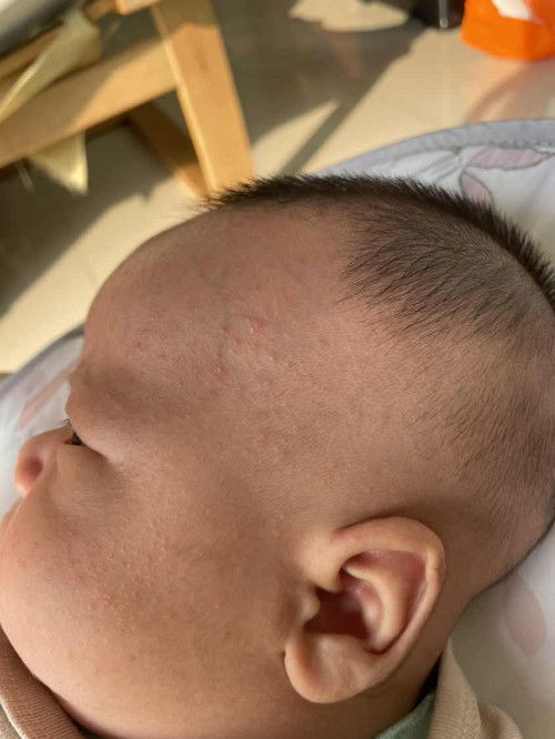 Beruntusan Merah di Wajah dan Kepala Bayi