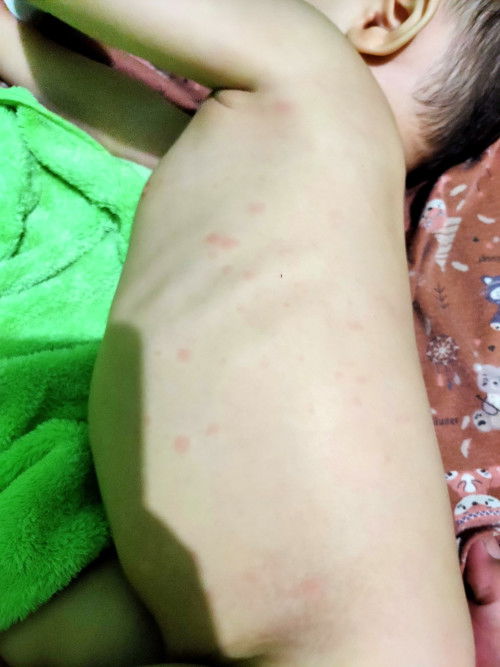 Muncul ruam merah setelah demam 3 hari