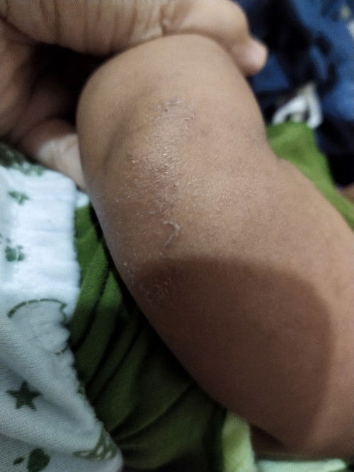 Siku bayi kasar kering