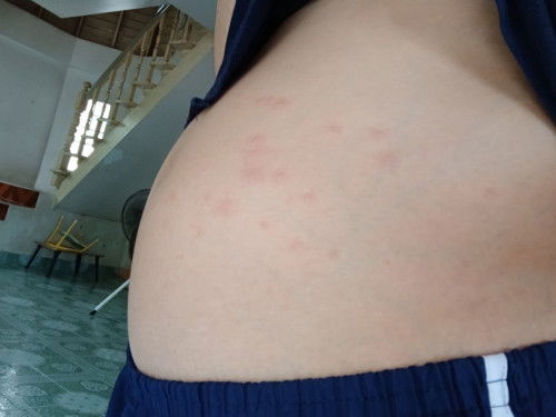 19week5day มีผื่นขึ้นท้องข้างขวา