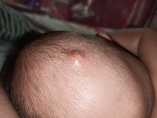 Bukol sa ulo ni baby