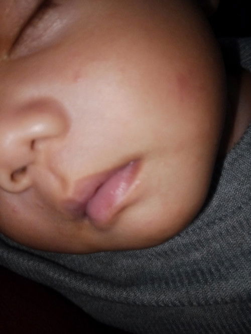 Pipi bayi bintik bintik