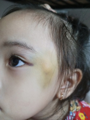 July 26, 2024 nagkabukol sa ulo anak ko pero until now july 30 meron paring malambot na bukol