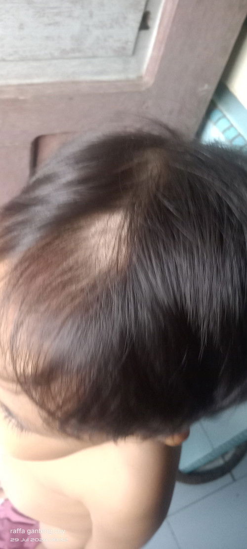 Bunda mau tanya adakah anak bunda ngalamin hal yg sama kayak anak saya..
Kepala nya tiba2 ada pitak