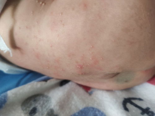 Hello mga mie ano gamit nyo ara mawala ang ganyan ni baby