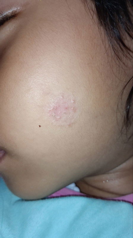 GATAL BENTUK BULAT DI PIPI ANAK