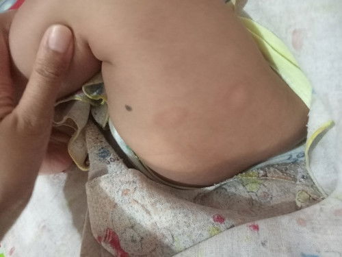 Bercak putih seperti panu