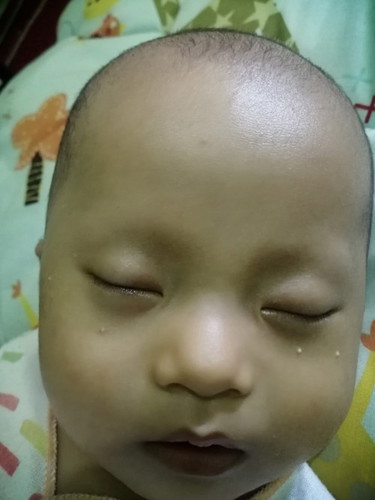 Bintik dimuka