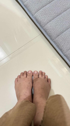 Kaki bengkak