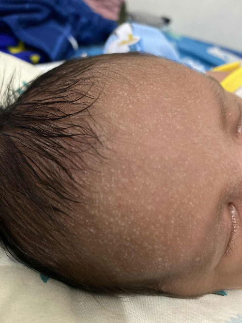 Beruntusan di jidat bayi