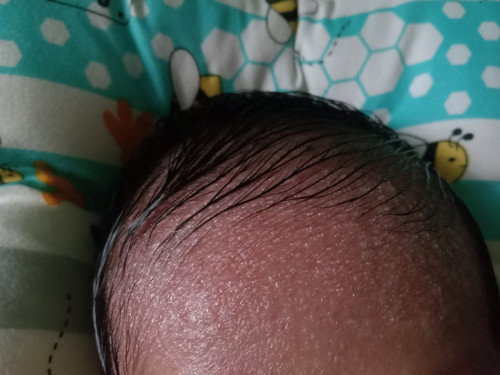 Jidat anak bintik bintik air