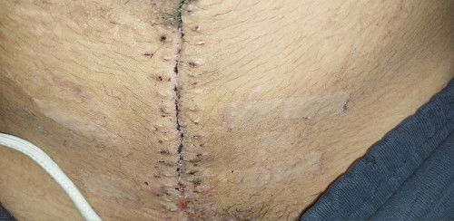 วิธีรักษาแผลหลังผ่าลอด