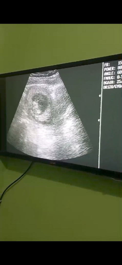 Pendarahan hebat di usia 12weeks,