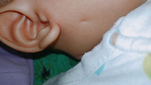 Ask ko lang po mag 4months na baby ko since birth may ganyan na sya,,butas tagos sa loob ng tenga