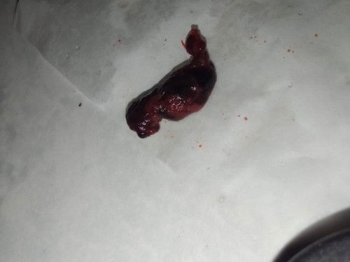 Ini darah haid atau janin ya bund?