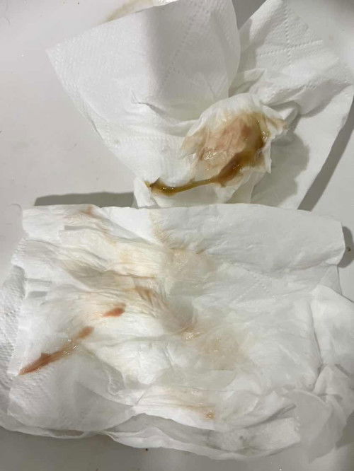 อายุครรภ์38+4มีมูกแบบนี้ออกมาแต่ไม่ปวดท้อง 
ต้องรอให้ปวดก่อนค่อยไปหาหมอมั้ยคะ