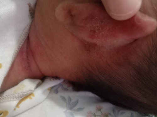 Kering ijo2 di sekitar muka