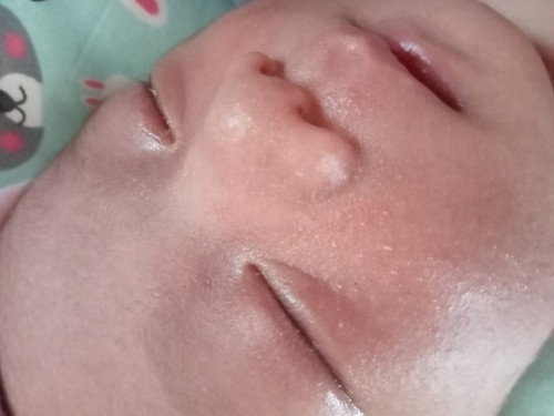 Bayi beruntusan