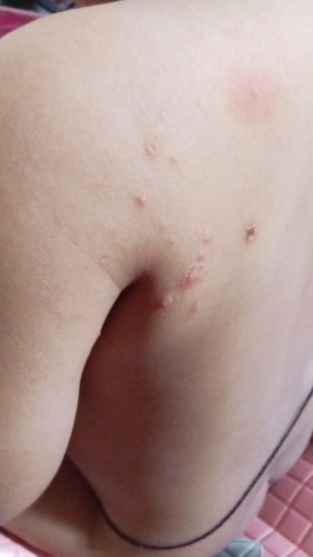 Kulit seperti melepuh