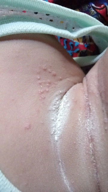 Hi mommy semua nak tanya bintik-bintik apa ni ruam ke atau apa?