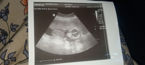 Kenapa Ari" ada di atas badan bayi , normal kah bun