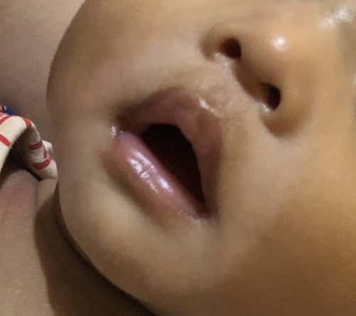 Eksim (dermatitis atopik)