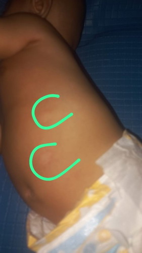 bayiku usia 4 bulan ada ruam merah bercak putih di badan nya ,kira kira kenapa yah bun ?