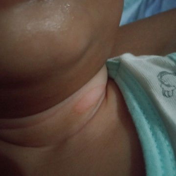 Malapad na pantal sa leeg ni baby