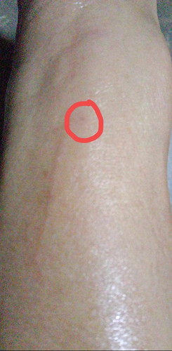 Scratches and bite of a dog