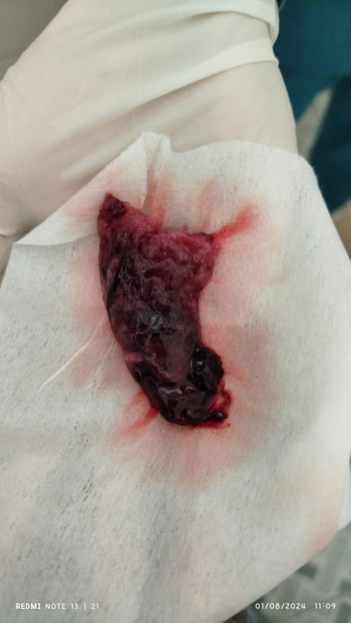 Keguguran usia kandungan 7 minggu sidah berbntuk mata