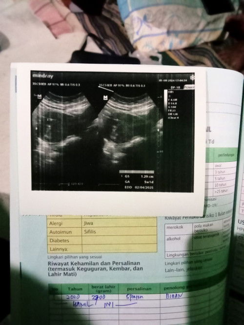 Hpht 1juni, haid maju mundur klo sesuai hpht 8mgg usg 5mgg&sempat flek dikit sehari, doain ya bun