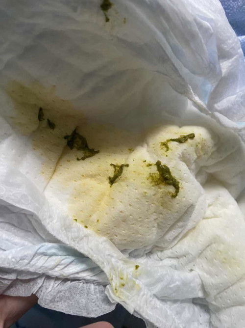 อึแบบนี้ปกติมั้ยคะ