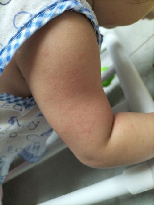 ฉีดวัคซีน9เดือน  หลัง1เดือนมีผื่นขึ้นตามร่างกาย