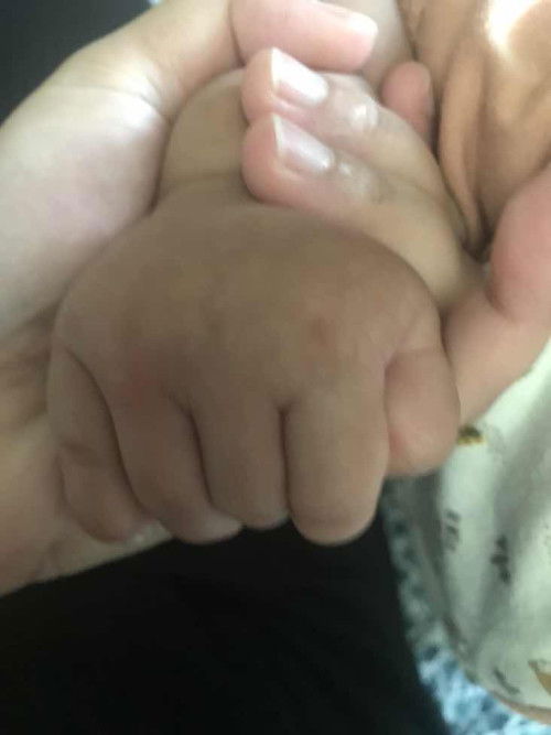 Gigitan semut atau alahan ?